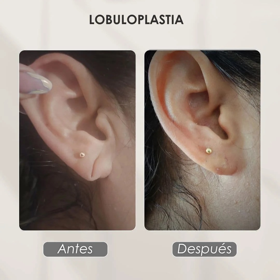 Loboplastia caso 3 — antes y después